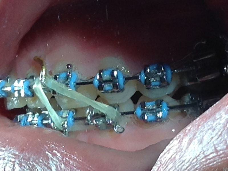 Wyciągi gumowe rozciągane między poszczególnymi zębami